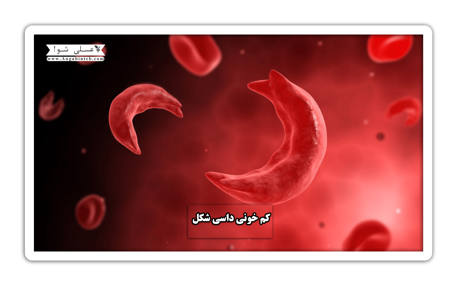 Sickle cell anemia-title